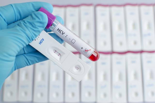 Srbija uvodi savremenu terapiju za hepatitis C